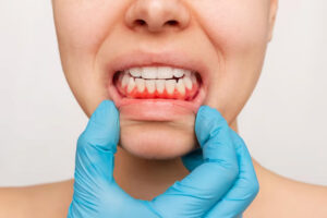 Relación entre la salud dental y la salud del corazón 8 una chica muestra que tiene las encías muy inflamadas sujetándose el labio inferior con su mano, en la que tiene puesto un guante de látex azul